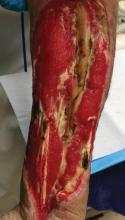 Figure 3. Necrotizing fasciitis of the left forearm following debridement of the skin, subcutaneous tissue, and fascia, revealing the remaining muscle, tendon, and bone