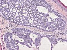 Figure 3. Thin strands of basaloid cells in a reticulate pattern with prominent stromal mucin in adenoid basal cell carcinoma. There also is palisading and retraction artifact of conventional basal cell carcinoma (H&E, original magnification ×40).