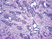 Figure 5. Invasive ductal structures of malignant eccrine carcinoma (H&E, original magnification ×100).