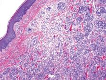 Figure 6. The dermis is filled with malignant glandular epithelium that is CK7 positive, CK20 negative, and thyroid transcription factor 1 positive (immunohistochemistry not shown), consistent with metastatic adenocarcinoma of lung origin (H&E, original magnification ×40).