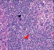 Figure 3. A high-power photomicrograph showed lymphoid cells admixed with immunoblasts (black arrowhead) and plasma cells. Vascular proliferation (red arrowhead) also was noted (H&E, original magnifi-cation ×400).