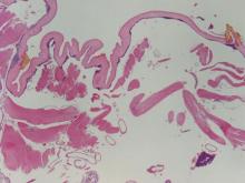 Figure 3. A fly larva demonstrates a thick hyaline cuticle with yellow spikes, characteristic of myiasis (H&E, original magnification ×40). 