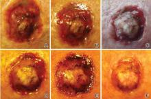 Keratoacanthoma recurrence at day1 (A), day 3(B), day 5 (C),day 6(D), day 7 (E), and day 9 (F) following electrodesiccation and curettage.