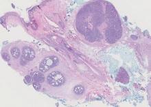 Figure 1. Two distinct neoplasms are apparent, side by side, with an intervening hair follicle. The spirade-noma (right) is a large, sharply demarcated, rounded nodule of basaloid cells containing little cytoplasm. The trichoepithelioma (left) is composed of lobules