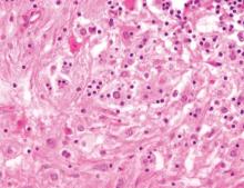 Figure 3. Sea of pale histiocytes with a patchy infiltrate of lymphocytes and plasma cells seen in cutaneous Rosai-Dorfman disease. Lymphocytes are seen within the cytoplasm of the histiocytes (emperipolesis)(H&E, original magnification ×200).