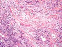 Figure 4. Necrobiotic collagen with abundant mucin surrounded by palisaded histiocytes, often with eosinophils characteristic of granuloma annulare (H&E, original magnification ×100).