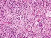  Figure 5. Touton giant cells and occasional eosinophils in a sea of histiocytes and lymphocytes characterize juvenile xanthogranuloma (H&E, original magnification ×200).