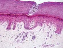 Figure 3. Cytologically normal melanocytes in the lower half of the epidermis in a benign acral nevus with a thick stratum corneum that is indicative of acral skin (H&E, original magnification ×20).