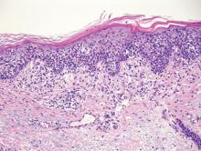 Figure 5. Atypical lymphocytes in the epidermis of mycosis fungoides display nuclei that are large, dark, and have irregular nuclear contours with perinuclear clearing (H&E, original magnification ×20).