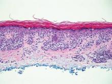 Figure 6. Nests of atypical melanocytes predominately involving the basal layer in superficial spreading melanoma in situ (H&E, original magnification ×20).