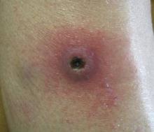 Figure 1. A large round, reddish purple, centrally ulcerated plaque with dark hemorrhagic crust and a surrounding patch of erythema inferior to the knee on the right lateral lower leg. 