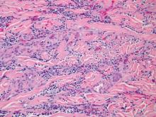 Figure 4. Leukemia cutis and numerous fungal hyphae demonstrated angioinvasion (H&E, original magnifi-cation ×200).