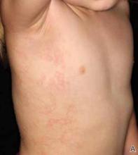 Erythematous Papules and Plaques on the Flank of a Child | MDedge