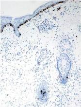 Figure 4. Immunohistochemical staining for HMB-45 showed preservation of melanocytes in the hair bulbs (original magnification ×20).