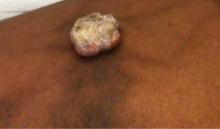 Figure 1. An exophytic, hyperkeratotic, erythematous nodule with surrounding hyperpigmentation on the anterior aspect of the left thigh. 