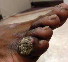 Figure 3. A hyperkeratotic, papillated, hard nodule with a rough surface on the right fifth toe.