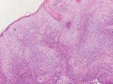 Figure 3. Sections of a biopsy from an inverted follicular keratosis show an endophytic lesion with acanthosis consisting of fairly uniform squamous cells with eosinophilic cytoplasm. Numerous squamous eddies can be seen (H&E, original magnification ×100). 