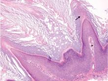 Figure 5. Compact hyperorthokeratosis with tiers of parakeratosis (arrow), digitated epidermal hyperplasia, hypergranulosis, vacuolated granular layer cells, and small blood vessels extending into the tips of the dermal papillae (asterisk) in the setting of a verruca vulgaris (H&E, original magnification ×100). 