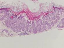 Figure 6. A cup-shaped invagination filled with cornified material and surrounded by slight epidermal hyperplasia in association with acantholytic dyskeratosis in a warty dyskeratoma (H&E, original magnifi-cation ×100).