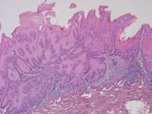 Excisional biopsy of the verrucous nodule revealed marked acanthosis of the epidermis and bulbous projections of epithelium extending into the dermis. The endophytic “pushing border” supported a diagnosis of verrucous carcinoma (H&E, original magnification ×100).