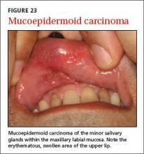 Oral lesions you can’t afford to miss | MDedge Family Medicine