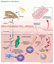 Celiac disease: Managing a multisystem disorder | MDedge Family Medicine