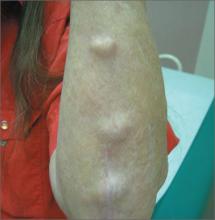 Lumps on forearm | MDedge Family Medicine