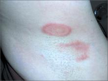 Pruritic rash in axilla | MDedge Family Medicine