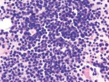 Shown is a histopathologic image of multiple myoloma with bone marrow aspirates, done with hematoxylin & esoin stains.