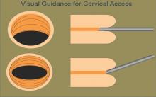 An angled scope allows optimal visualization of the uterine cavity with minimal movement of the scope. However, the surgeon must be cognizant of the view provided to keep the scope aligned with the cervix and uterus to reduce tissue trauma and bleeding.