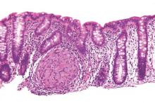 High magnification micrograph of Crohn's disease. Biopsy of colon. H&E stain.