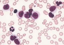 Bone marrow smear from a patient with acute myelomonocytic leukemia.