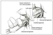 FIgURE 3 Palpate the ureters Place an index finger into the anterior cul-de-sac and palpate the ureter against the Deaver retractor at the 2- to 3-o’clock position. 