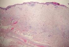 Figure 1. Desmoplastic melanoma with spindle melanocytes in a densely fibrotic stroma (H&E, original magnification ×40). 