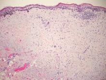 Figure 2. Confluence of atypical melanocytes along the dermoepidermal junction consistent with melanoma in situ overlying desmoplastic melanoma (H&E, original magnification ×100).