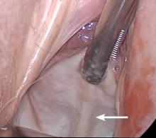 FIGURE 2 Tent the vaginal tissue Once you have achieved a right angle, tent the vaginal tissue in the midline (arrow). 