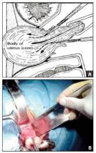 Uterine reduction: Core the central portion of the uterus while grasping the cervix (A, B) to remove the endometrium intact for the pathologist. 