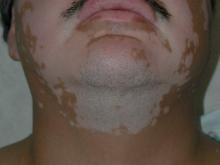 This case of vitiligo demonstrates bilaterally symmetric involvement, a stigmatizing location on the face in a patient with phototype 5 skin, and retention of pigment in the hair follicles, which is a good prognostic sign for response to therapy.