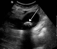 A 1.9-cm gallstone impacted in the neck of the gallbladder and leading to cholecystitis