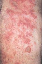 shingles = Confluent groups of vesicles in a highly inflamed case.