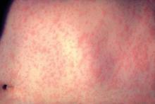 This is the skin of a patient after 3 days of measles infection, treated at the New York-Presbyterian Hospital.