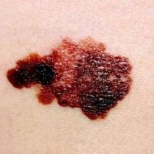 Typical dermoscopic features of cutaneous melanoma metastases include peripheral gray spots, atypical vessels, and a blue nevus-like pattern. 