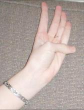 The thumb-palm sign: Note the extension of the thumb beyond the border of the flat palm. This indicates connective tissue disease and should prompt an aneurysm investigation.