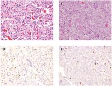 Histologic images of tumor stains with hematoxylin and eosin stain (A and C) and Ki-67% (B and D) at 20x magnification. A and B: Tumor sample from a patient with SDHB mutation and metastatic abdominal paraganglioma with Ki-67 1-3%. C and D: Tumor from a patient with sporadic pheochromocytoma and no recurrence with Ki-67% over 3%.