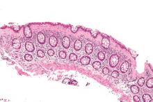 Intermediate magnification micrograph of collagenous colitis.