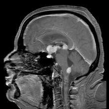 Brain MRI showing primary central nervous system B-cell non-Hodgkin lymphoma of the sella turcica and hypothalamus, continuing to the tectum.