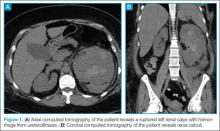 case study on kidney stone