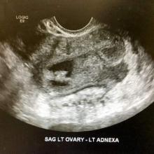 Ultrasound view of an endometrioma with a mural nodule.