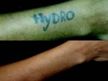 The treatment protocol for laser tattoo removal depends on the patient’s skin type, as well as on the type and density of inks used.