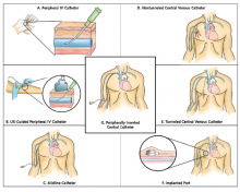 Vascular access devices reviewed to formulate appropriateness ratings.